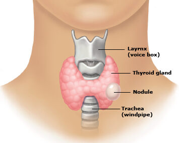 Thyroid lump
